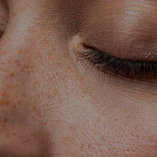 Soluciones de skincare coreano para piel con grasa problemática y acné